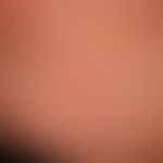 Sweet syndrome: reddish-livid, succulent, pressure-dolent, infiltrated, solitary and partly papul...
