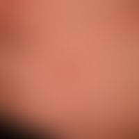 Sweet syndrome: reddish-livid, succulent, pressure-dolent, infiltrated, solitary and partly papul...