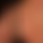 Sweet syndrome: reddish-livid, succulent, pressure-dolent, infiltrated, solitary and partly papul...