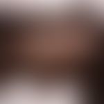 Hidradenom noduläres: eher zufällig entdecktes, völlig sympotmloses,&nbsp; ekkrines Schweißdrüsen...