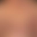 Primär kutanes CD30 positives großzelliges T-Zell-Lymphom: seit 2 -3 Jahren Knotenbildungen der H...