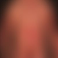 Psorisis, plaque type: chronic relapsing-active psoriasis with larger, in places confluent plaque...