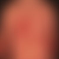 Psorisis, Plaque-Typ: chronische schubaktive Psoriasis mit größeren, stellenweise konfluierten Pl...