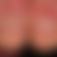 Nagelpsoriasis: unspezifische Nageldystrophie (die in dieser Weise auch bei chronischer Handderma...