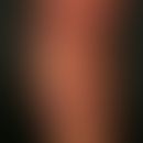 Aggressives zytotoxisches epidermotropes CD8-positives T-Zell-Lymphom: generalisierte, sich schne...