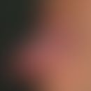 Haarleukoplakie orale. "Klassischer Befund" mit völlig sympotmlosen, niht abstreifbaren, flächige...
