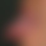 Hair leukoplakia orale. "Classic finding" with completely sympotmless, not strippable, flat, whit...