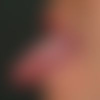 Hair leukoplakia orale. "Classic finding" with completely sympotmless, not strippable, flat, whit...