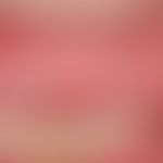 Leukoplakie, orale: &nbsp;chronisch stationäre (Dauer unklar), streifenförmige,&nbsp; schmerzlose...