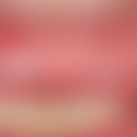 Leukoplakie, orale: &nbsp;chronisch stationäre (Dauer unklar), streifenförmige,&nbsp; schmerzlose...