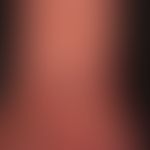 Acrodermatitis chronica atrophicans: Detail: livid, unscnarf limited, changeable colored erythema...