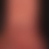 Acrodermatitis chronica atrophicans: Detail: livide, unscnarf begrenzte, wechselhaft gefärbte&nbs...
