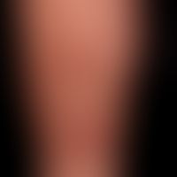 Nummular dermatitis (eczema, microbial): Itchy, scaly, coin-shaped plaques on the lower leg that ...