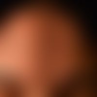Scléroderma en coup de sabre: since early adolescence, a continuously increasing, symptom-free fu...