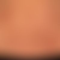 Dermatitis herpetiformis: Intensely itchy to painfully stinging urticarial plaques with tiny blis...