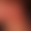 Epidermolysis bullosa dystrophica dominans: 35 Jahre alte Patientin, mit großflächiger vernarbend...