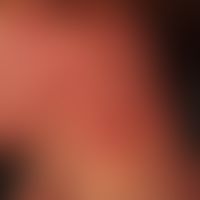 Epidermolysis bullosa dystrophica dominans: 35-year-old female patient, with extensive scarring b...