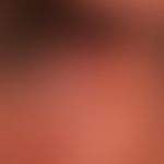 Primary cutaneous follicular center lymphoma: Condition after treatment of an alopecia areata wit...
