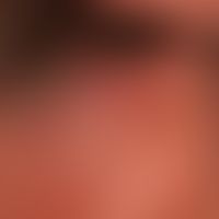 Primary cutaneous follicular center lymphoma: Condition after treatment of an alopecia areata wit...
