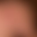 Zoster ophthalmicus:&nbsp;seit wenigen Tagen zunehmende, linksseitige Kopfschmerzen mit geringem ...