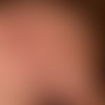 Zoster ophthalmicus:&nbsp;seit wenigen Tagen zunehmende, linksseitige Kopfschmerzen mit geringem ...