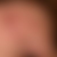 Zoster ophthalmicus:&nbsp;seit wenigen Tagen zunehmende, linksseitige Kopfschmerzen mit geringem ...