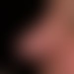Diffuse rhinophyma: distinct uniform disturbance of the shape of the nose due to diffuse phymogen...