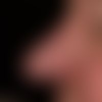 Diffuse rhinophyma: distinct uniform disturbance of the shape of the nose due to diffuse phymogen...