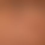 Larva migrans: encircles an older, already healed focal point and shows the linear progression of...