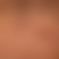 Larva migrans: encircles an older, already healed focal point and shows the linear progression of...