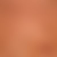 Erythema multiforme: suddenly occurring, itchy, disseminated exanthema with cocard-like plaques, ...