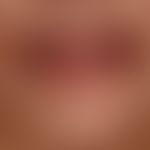 erythema multiforme: multiple, highly acute, since a few days existing, extensive, encrusted eros...