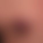 Acute inflammatory nodules: previously long-standing epidermoid cyst which has burst after accide...