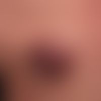 Acute inflammatory nodules: previously long-standing epidermoid cyst which has burst after accide...