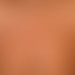 Pityriasis versicolor alba: spritzerartige und feinfleckige Depigmentierungen mit feiner Oberfläc...