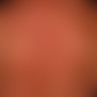 Systemic lupus erythematosus: acute maculopapular exanthema, accompanied by recurrent fever attac...