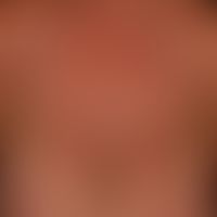Systemic lupus erythematosus: acute maculopapular exanthema, accompanied by recurrent fever attac...