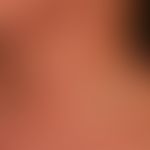 Systemic lupus erythematosus: acute maculopapular exanthema, accompanied by recurrent fever attac...