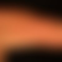 Systemic lupus erythematosus: acute maculopapular exanthema, accompanied by recurrent fever attac...