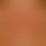 Systemic lupus erythematosus: detailed picture: acute maculo-papular exanthema, accompanied by re...