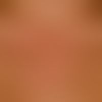 Systemic lupus erythematosus: detailed picture: acute maculo-papular exanthema, accompanied by re...