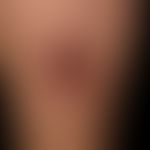 Cholesterinembolie: Patientin mit rezidivierenden, plötzlich auftretenden, sehr schmerzhaften, th...