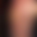 Melanom malignes amelanotisches: seit frühester Kindheit sei ein Pigmentmal an dieser Stelle beka...
