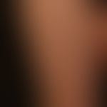 Urticaria pigmentosa:differently sized, disseminated, flat, oval or round, brownish-red spots on ...