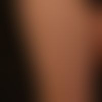 Urticaria pigmentosa: unterschiedlich große, disseminierte, flache, ovale oder runde,&nbsp;bräunl...