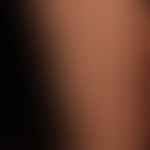Urticaria pigmentosa: same patient as before. 4 years later. Differently sized, disseminated, fla...