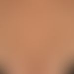 Urticaria pigmentosa: approx. 0.5-1.0 cm in size, disseminated, roundish, brownish-red spots. Onl...