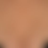 Urticaria pigmentosa: approx. 0.5-1.0 cm in size, disseminated, roundish, brownish-red spots. Onl...