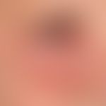 Herpes simplex virus infection: herpetiform, disseminated small blisters on reddened skin, perior...