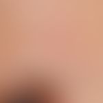 Herpes simplex virus infection:. grouped standing, crystal clear, shiny vesicles; no central nabe...